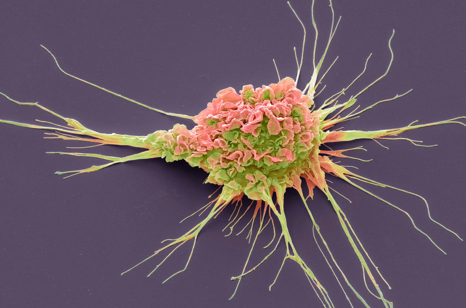 The patient’s own cells as therapy for rheumatoid arthritis