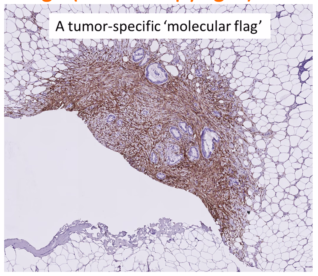 A theranostics approach to targeting aggressive colon cancer