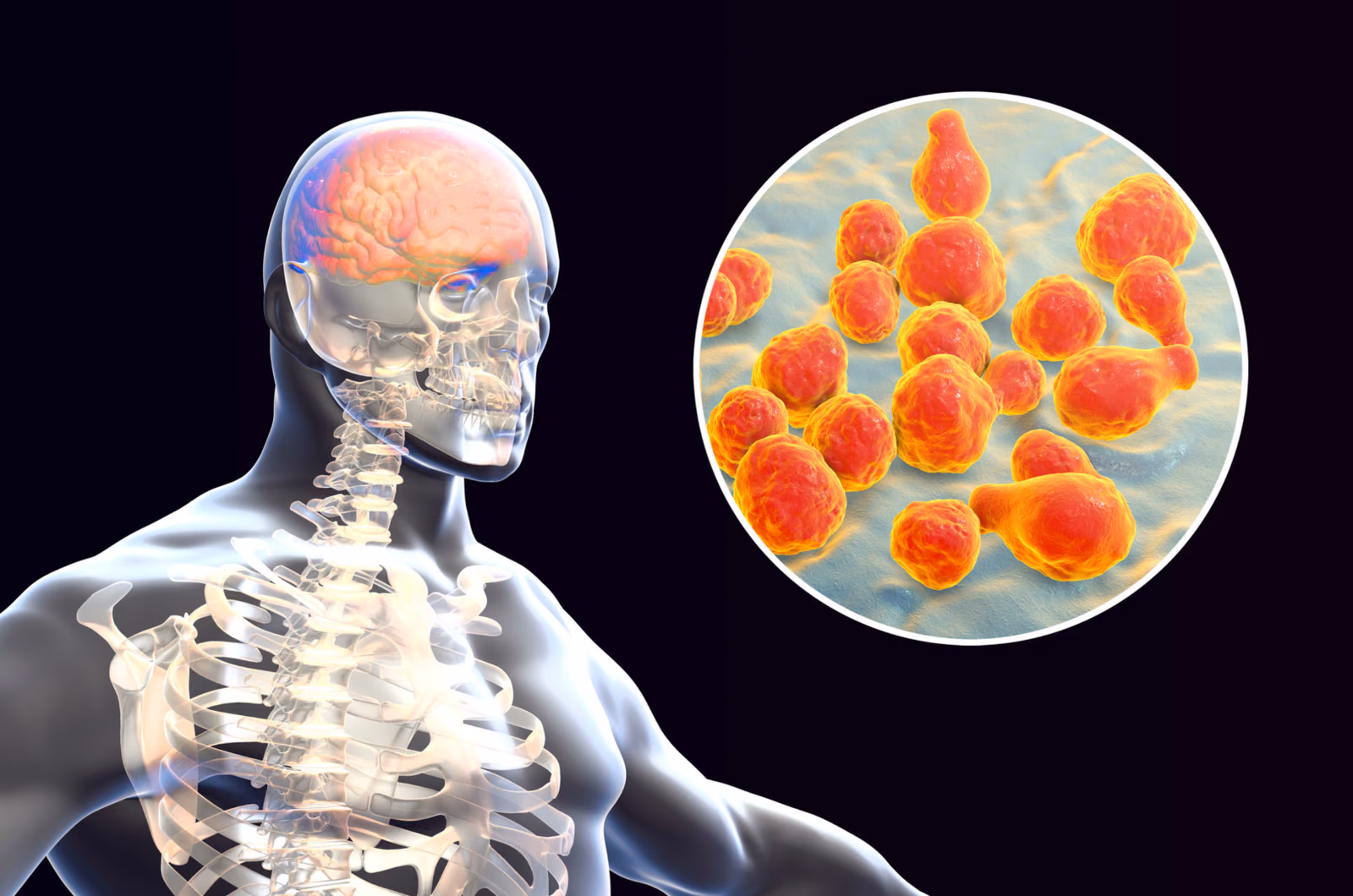 Mechanism of complement activation and amplification in bacterial meningitis