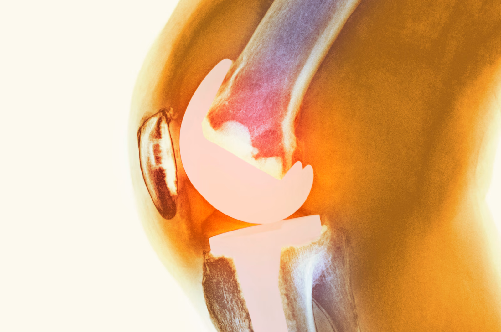 Personalised surgery optimization through precision and enhanced modelling