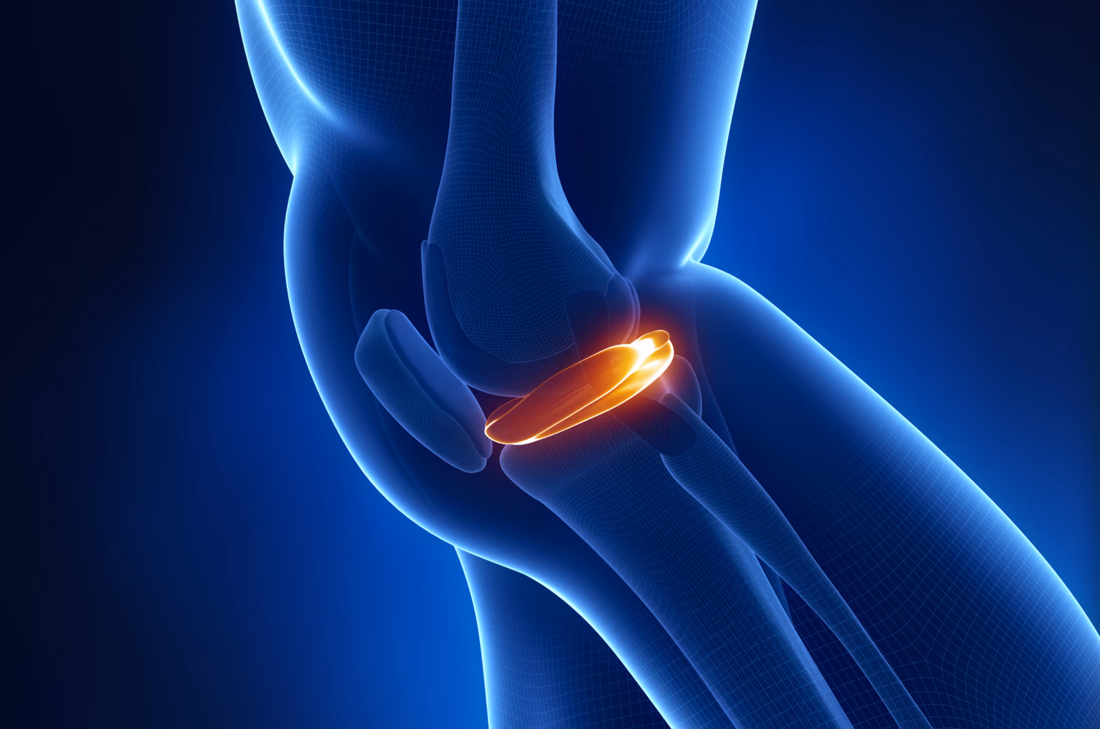 3D-Printed PCU meniscus Prosthesis (3PPP) for individual post-meniscectomy-pain relief