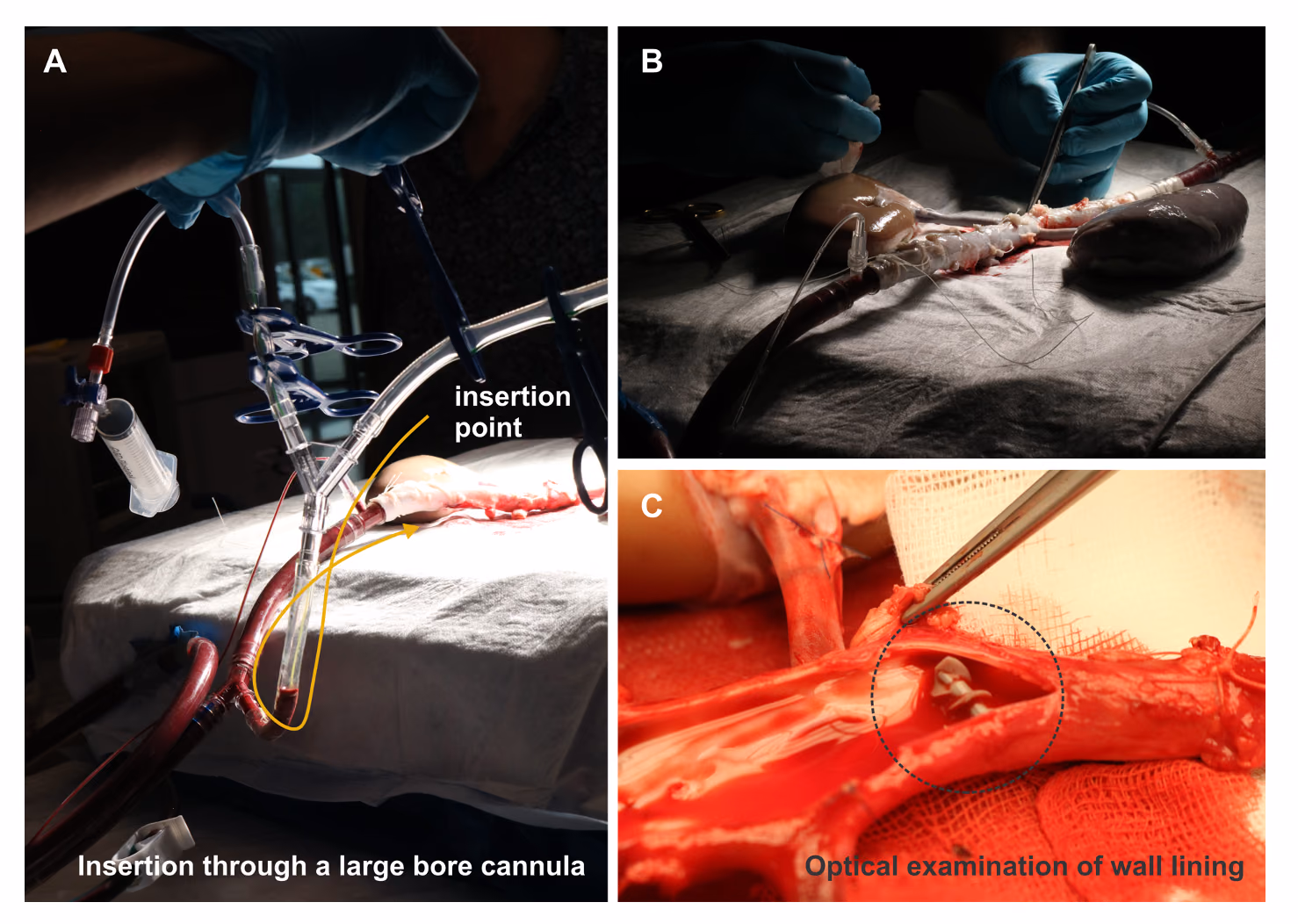 Wireless Clot Retriever Device for the Treatment of Acute Ischemia Stroke and Occlusions in Deep Seated Vessels