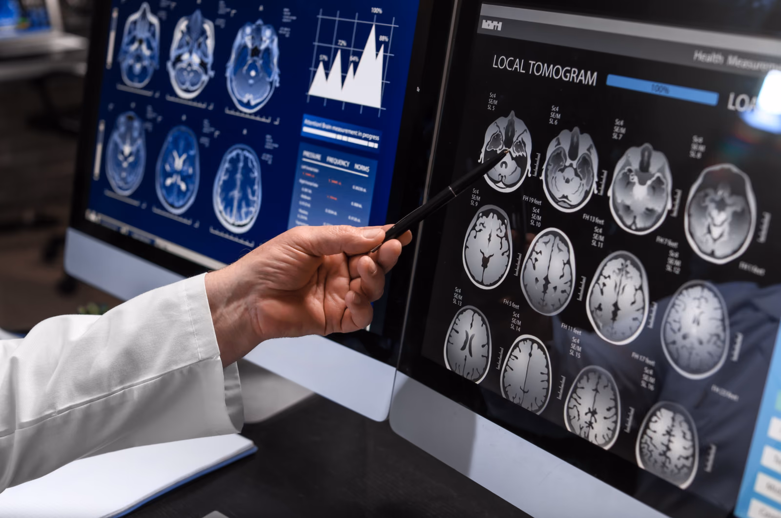 Early detectioN of thromboemboliC sources And smalL vOlume stroke with SpEctral ct (ENCLOSE)