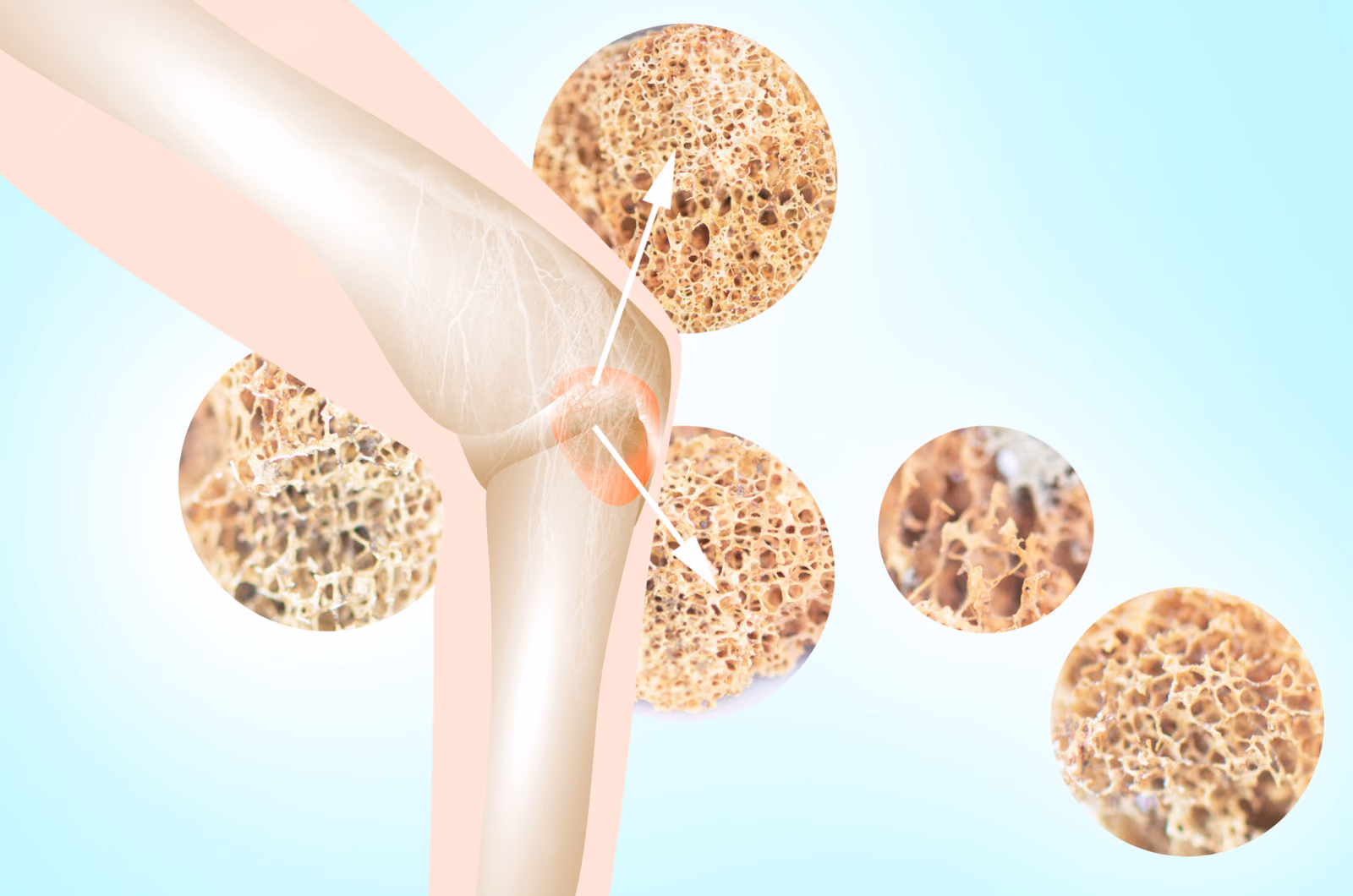 Boosting the bone biology in clinically important traumatic bone defects