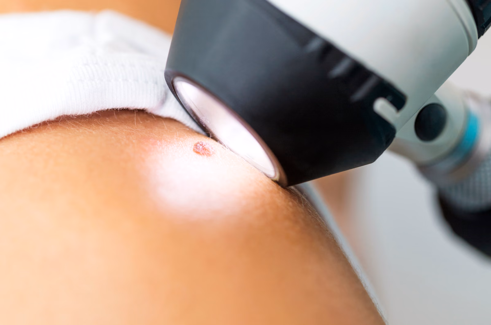 Combining a new laser-guided treatment for uveal melanoma with checkpoint inhibitors to prevent Loss of Vision and Save Lifes : Laserlmmune