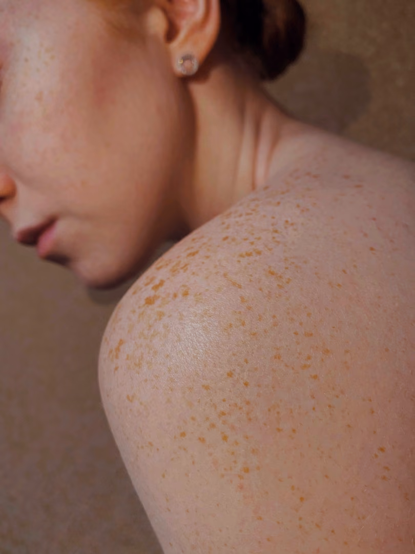 THe Risk among Early stage melanomA of distant meTastasis (THREAT)