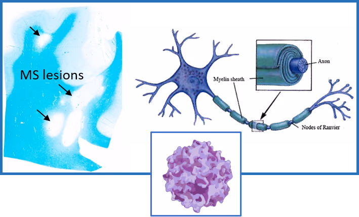 Development of a Non-Invasive Gene Therapy for Multiple Sclerosis. Acronym: GT-MS