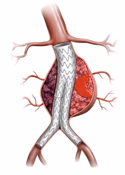 A Computational model to understand the Physiology, Etiology and Biological Behavior of Type II Endoleaks (CoφEndoleak).