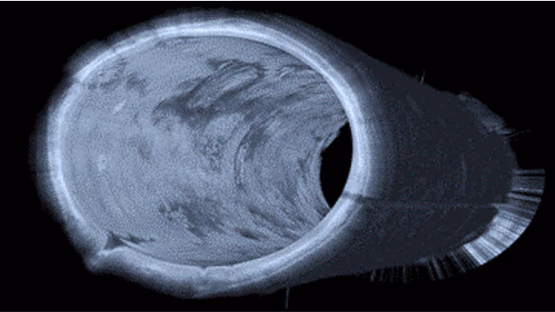 Volumetric Laser Endomicroscopy (VLE) for improved detection of early oesophageal cancer.