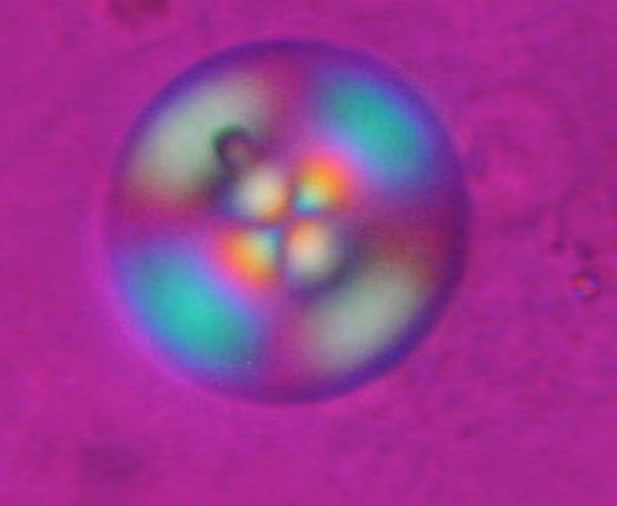 Human Crystal Diagnostics with hybrid Raman spectrograph and polarised light microscope