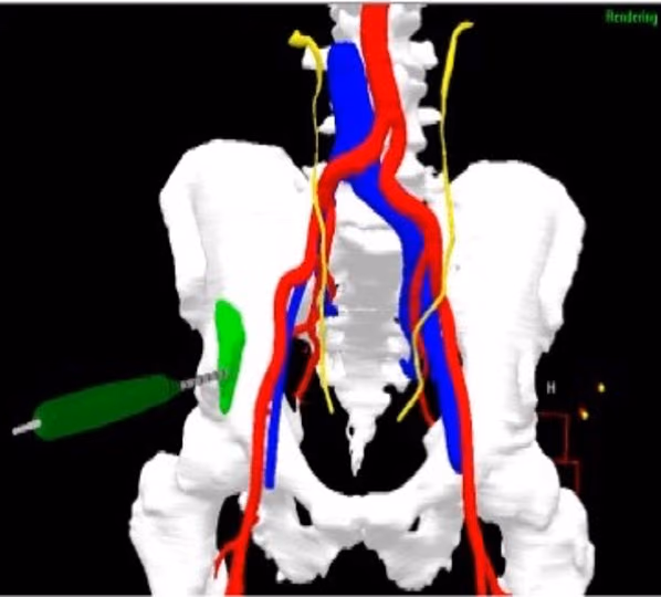 Smart electromagnetic sensor technology for surgical navigation