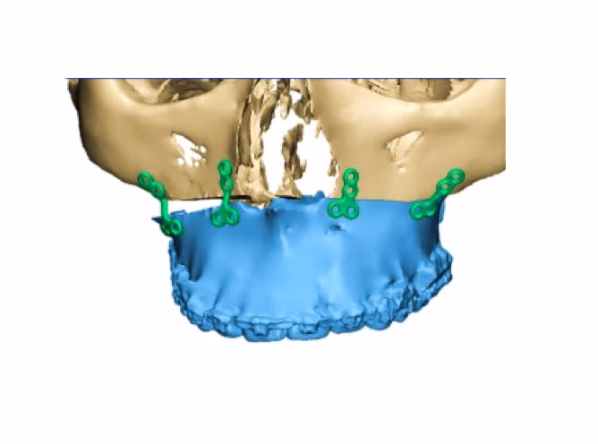PSO-trial: PSO in Orthognathic Surgery