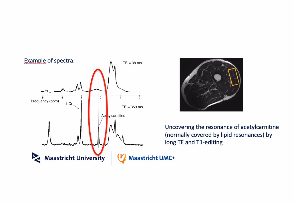 Carnitine supplementation as a therapy to improve insulin sensitivity in Type 2 diabetic patients with low carnitine status