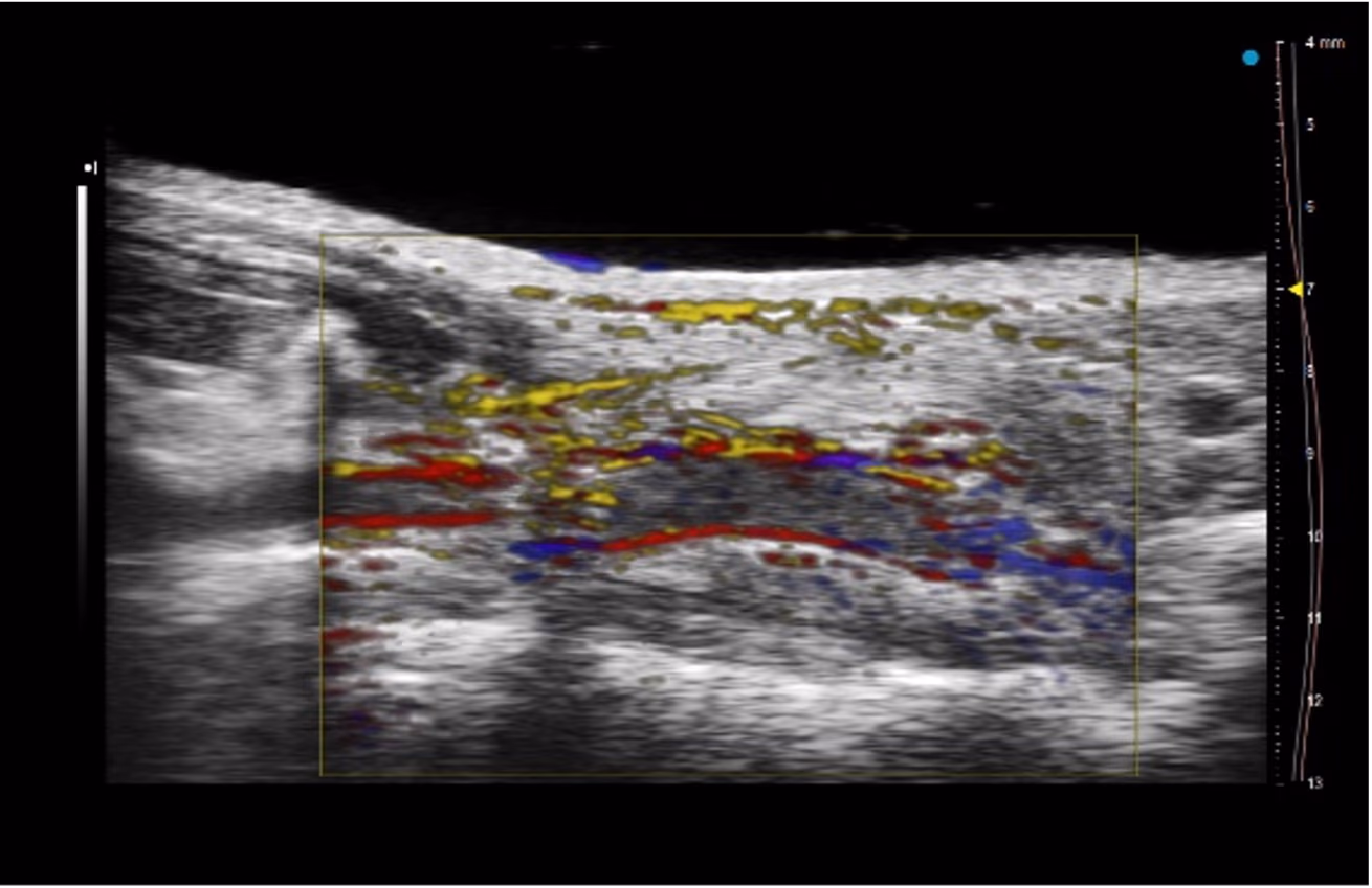 Non-Invasive Photoacoustic Analysis of Cardiovascular disease (NIPAC)
