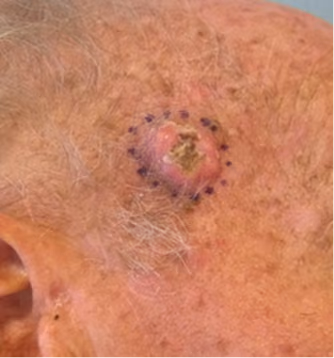 A stepwise prediction model integrating high-risk clinicopathological characteristics and genomics to identify advanced cutaneous squamous cell carcinoma (Step-Ident-CSCC Study)