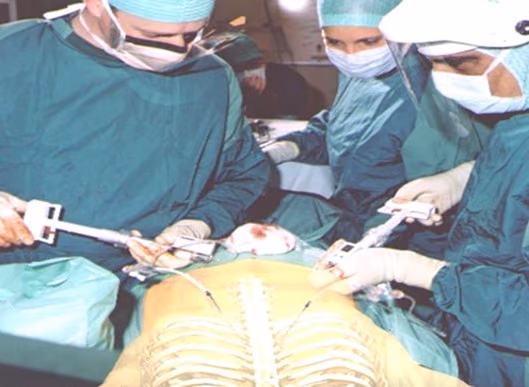Porospine: Porous Titanium Cages for Spine Fixation