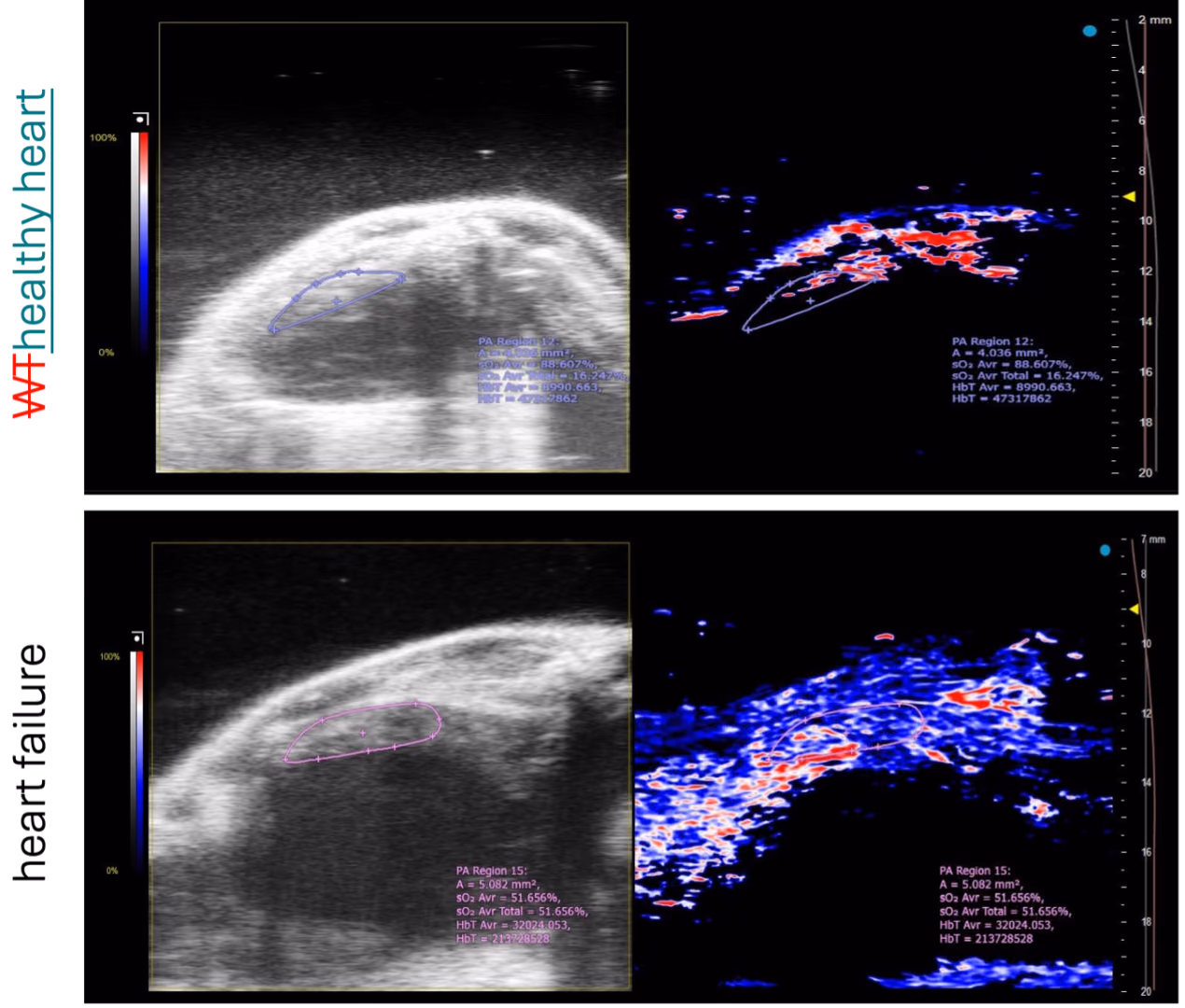 Photoacoustic imaging with contrast agents in heart failure