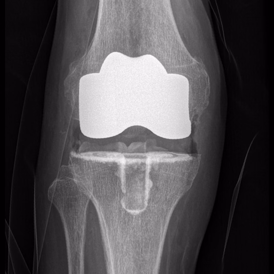 Advanced analysis of primary fixation of total knee arthroplasty components