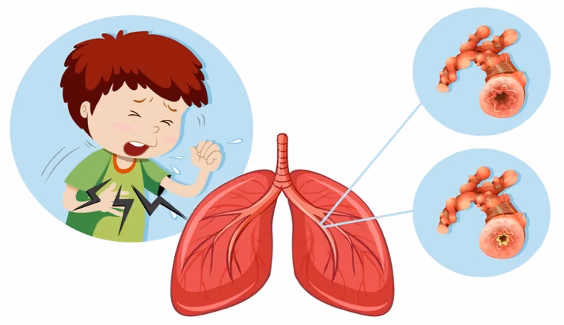SMART approach to COPD