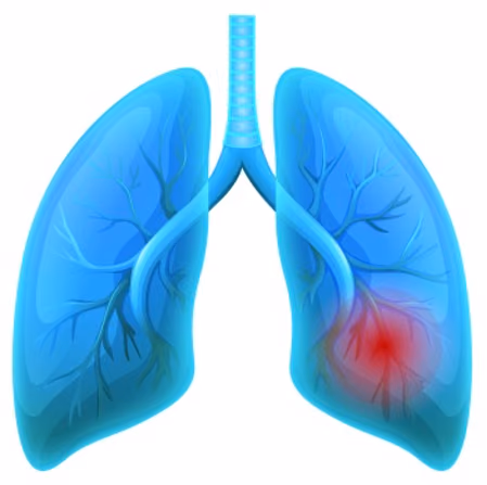 Single cell genomics of asthma remission – Open Target project