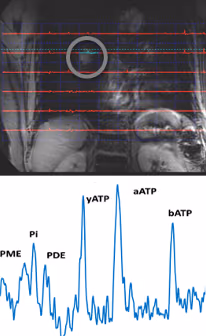 Non-Ionising Metabolic Imaging (NIMI) using robust phosphorus MRI to predict treatment efficacy
