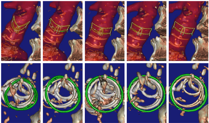 On evaluating stent-artery interaction in abdominal aortic stent grafting