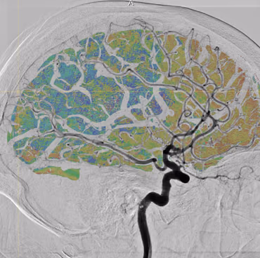 Q-Maestro: Quantification of brain reperfusion in X-ray images in endovascular treatment of stroke patients