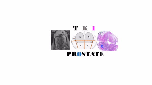 Personalised Prostate Cancer Management using Multi-parametric MRI and Machine Learning