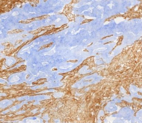 HLA-G as a new target for immune checkpoint inhibitors for cancer immunotherapy