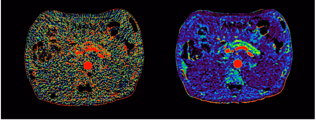 FILTER - Functional Imaging with Low dose cT pERfusion