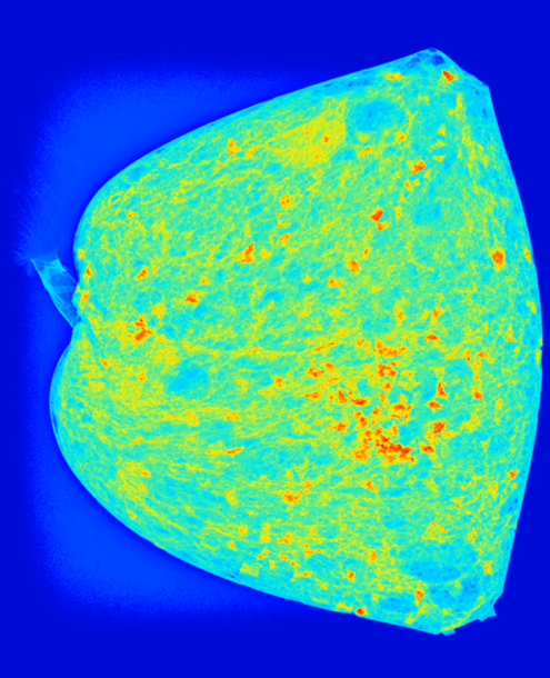 Deep learning analysis of mechanical breast compression: narrowing the gap between what the surgeon feels and what the radiologist sees