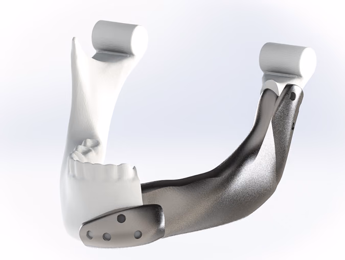 3D printed patient specific Titanium implants after segmental resection of the mandible