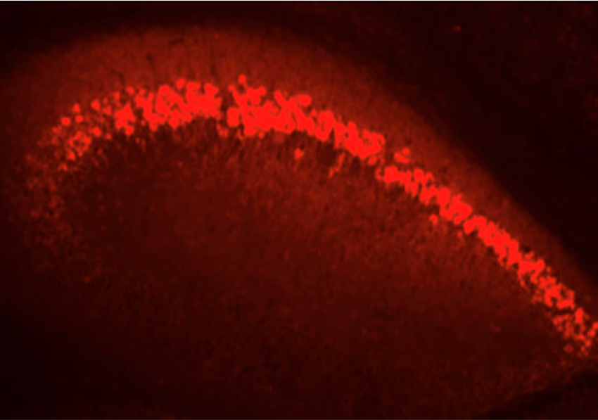 Alzheimer adenoviral gene therapy targeting amyloid beta oligomers