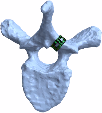 Safe Neurostimulation Against Pain (SNAP) : a new, minimally invasive, approach to pain mitigation using only electrodes outside the vulnerable epidural space