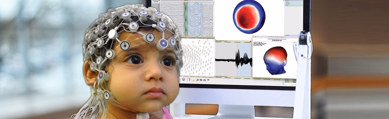 PerStim: personalised neurostimulation for non-invasive epilepsy treatment