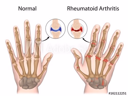 Hyper-glycosylation of Anti-Citrullinated Peptide Autoantibodies in Rheumatoid Arthritis