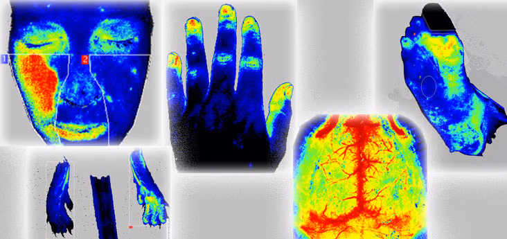 The use of innovative optical devices for diagnosis and treatment of the microcirculation in burns patients
