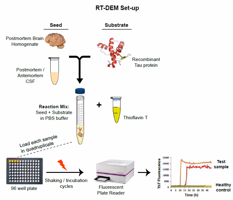 Detection of protein-aggregates for differential diagnosis of dementias by RT-DEM