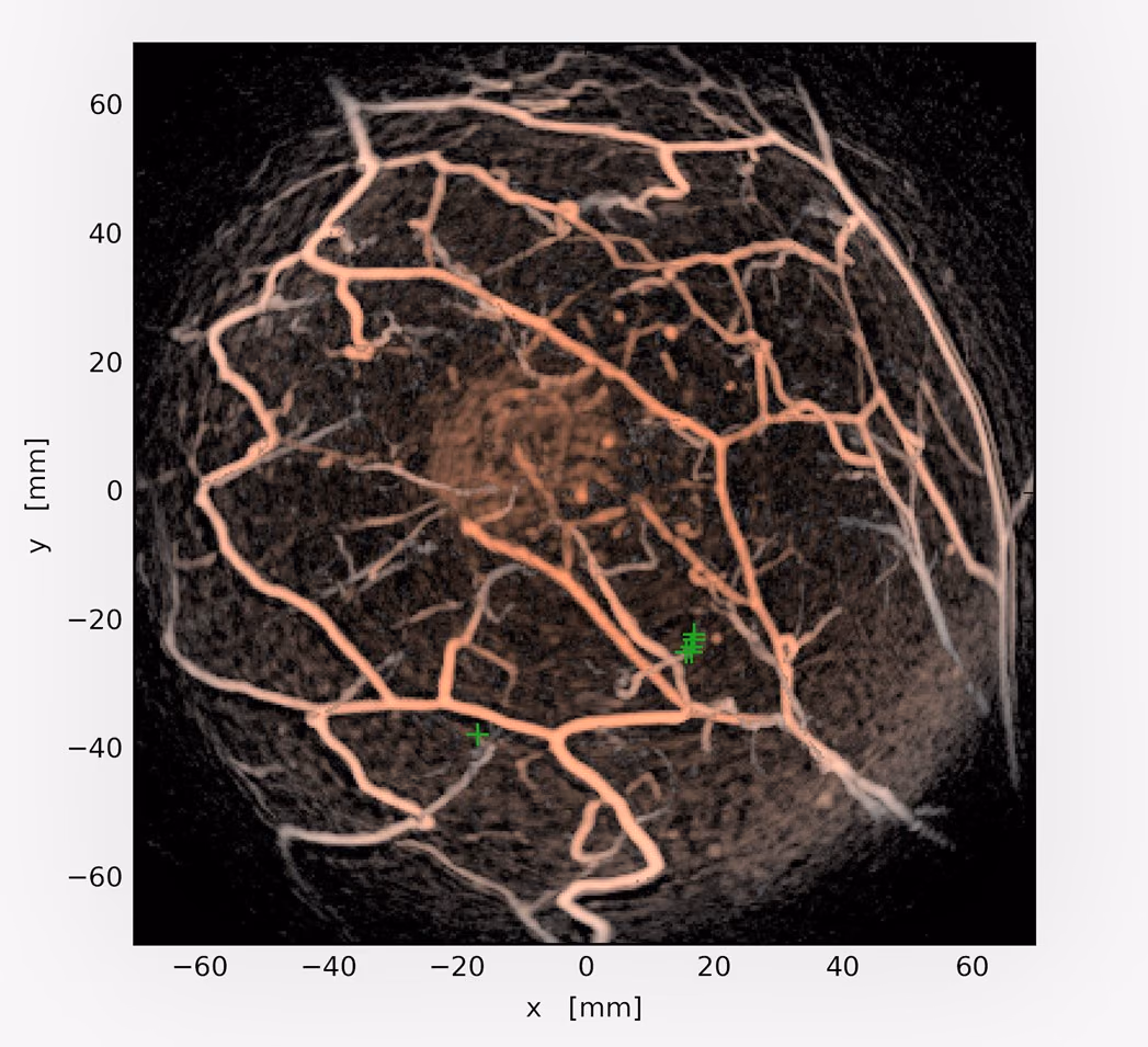 Signal Analysis & Complex Algorithms for Medical Image Reconstruction, subsequently applied to Photo-Acoustic Mammography (SACAMIR)