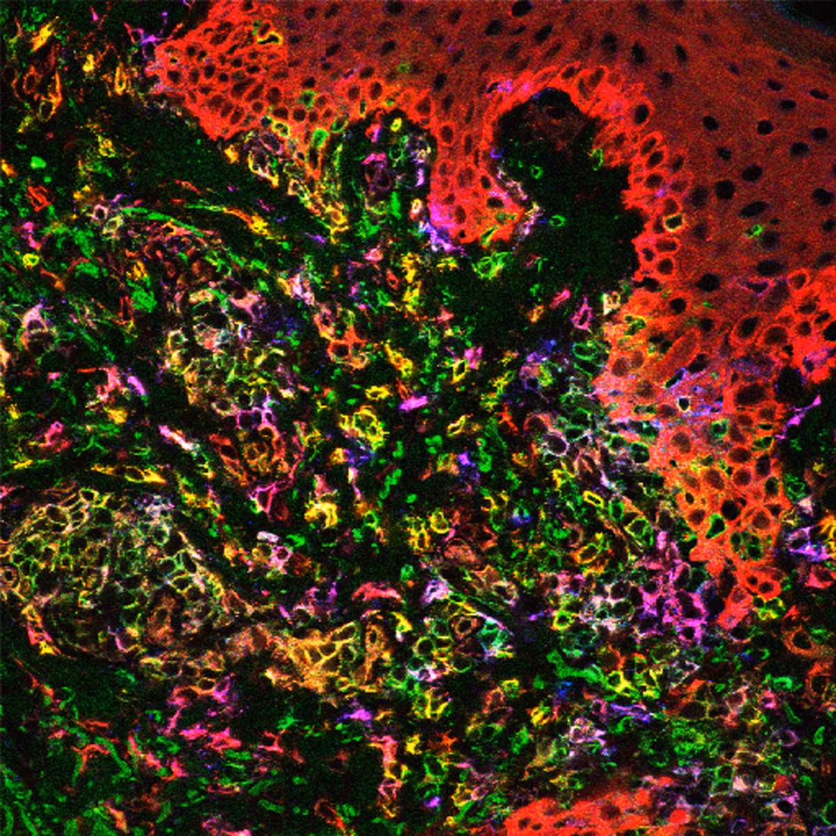 NeoVAC: a new class of innovative personalized cancer vaccines.