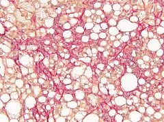 Resolving liver fibrosis with nutritional and therapeutic interventions.
