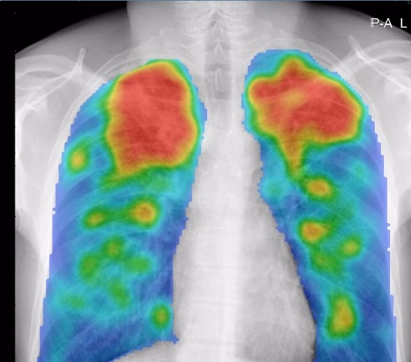 New screening tool for Tuberculosis