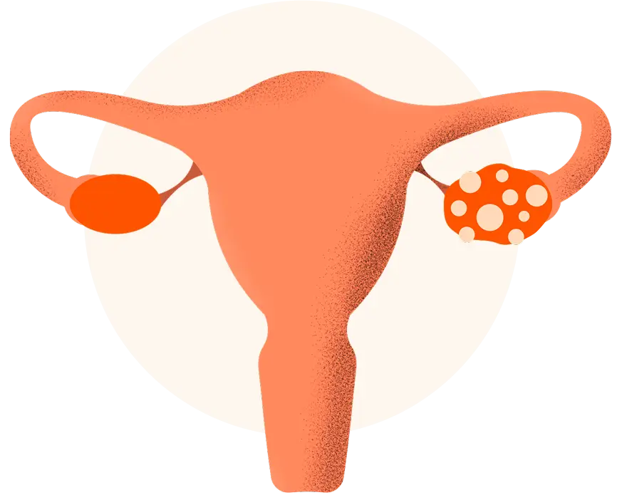 Illustration of a uterus with one ovary showing cysts represented by orange and white spots.