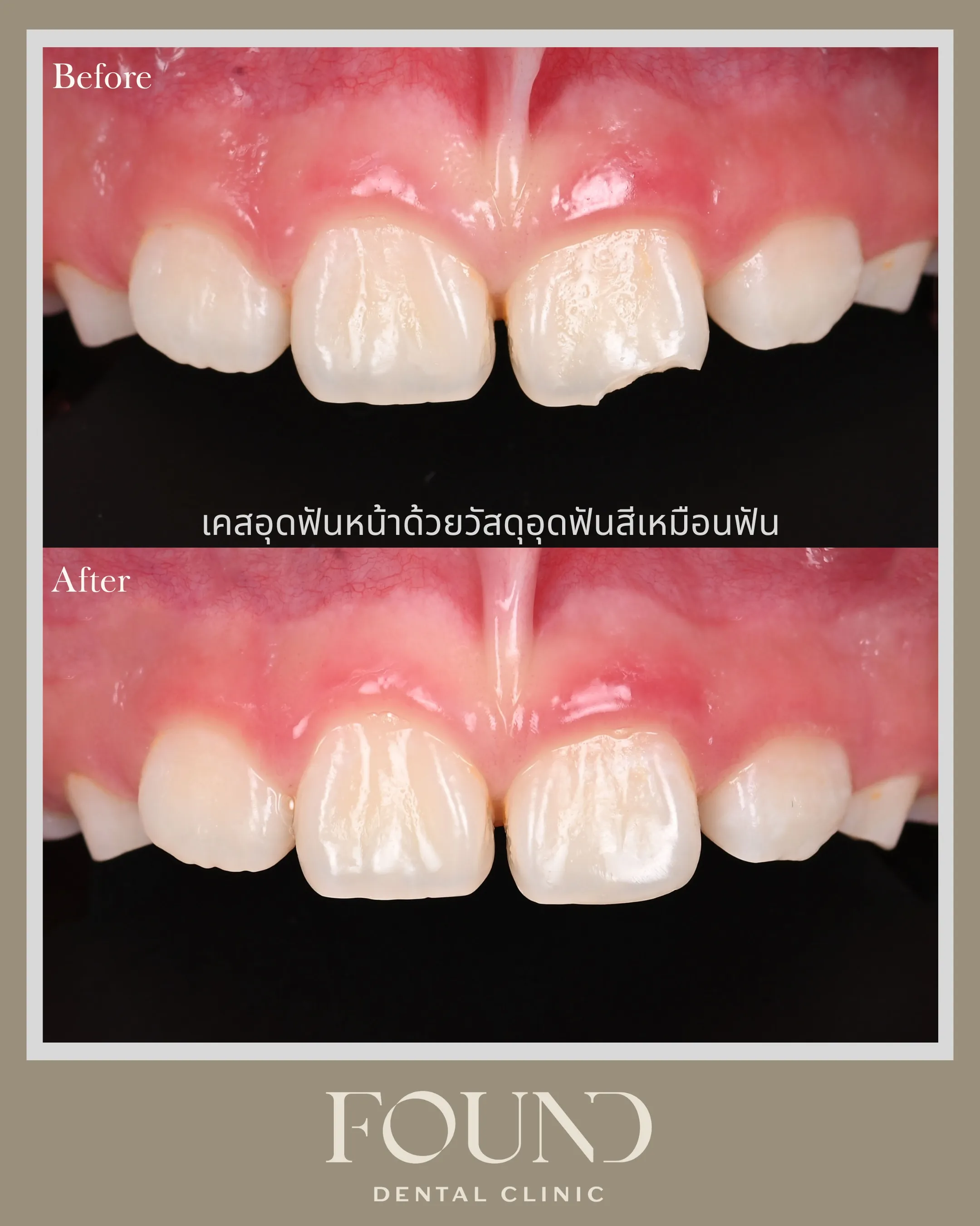 เคสก่อนและหลังอุดฟันหน้าที่บิ่นด้วยวัสดุอุดสีเหมือนฟัน ที่ FOUND Dental Clinic