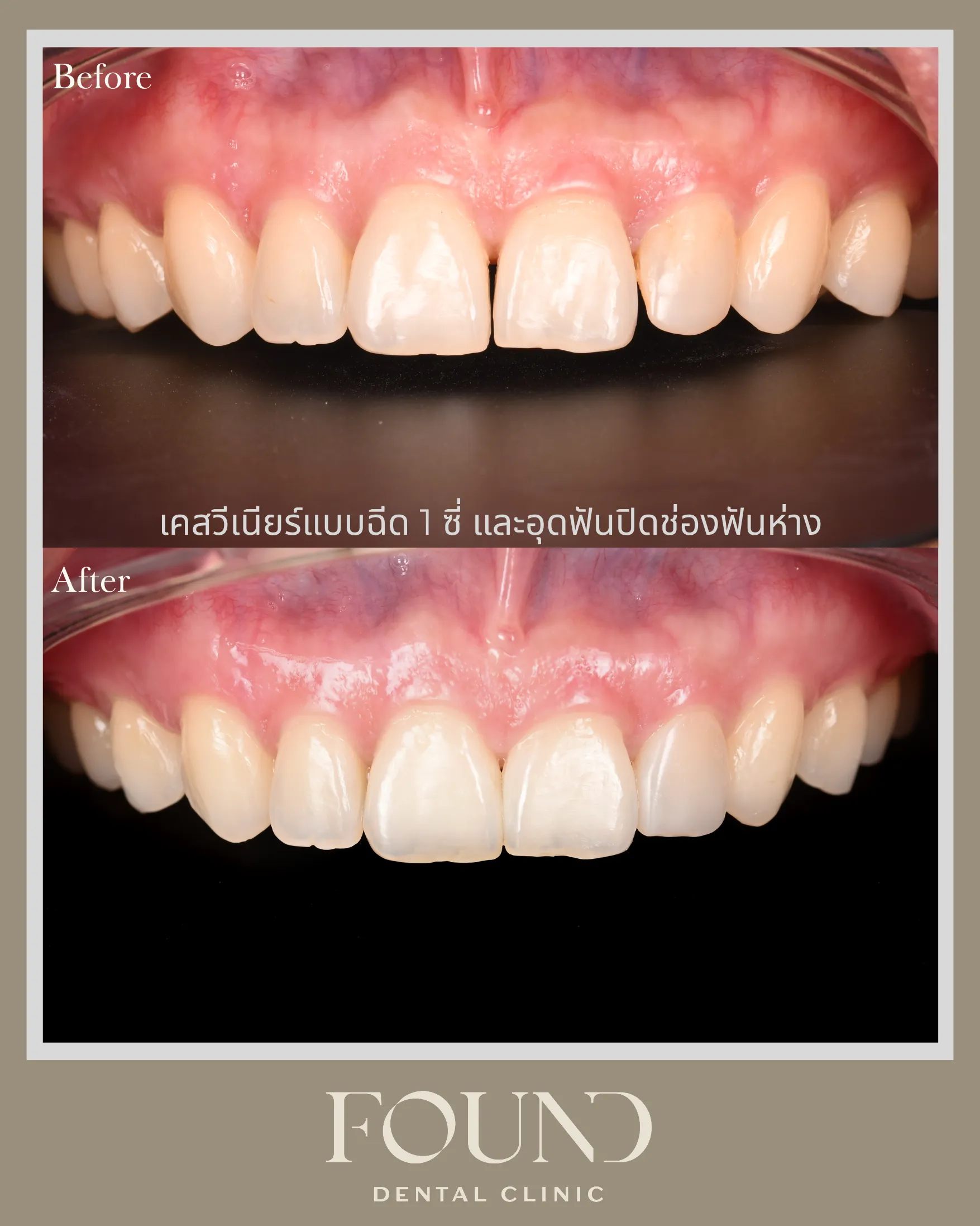 เคสก่อนและหลังทำวีเนียร์คอมโพสิตแบบฉีด 1 ซี่ และอุดปิดช่องฟันห่าง ถ่ายระยะใกล้เห็นฟันหน้า