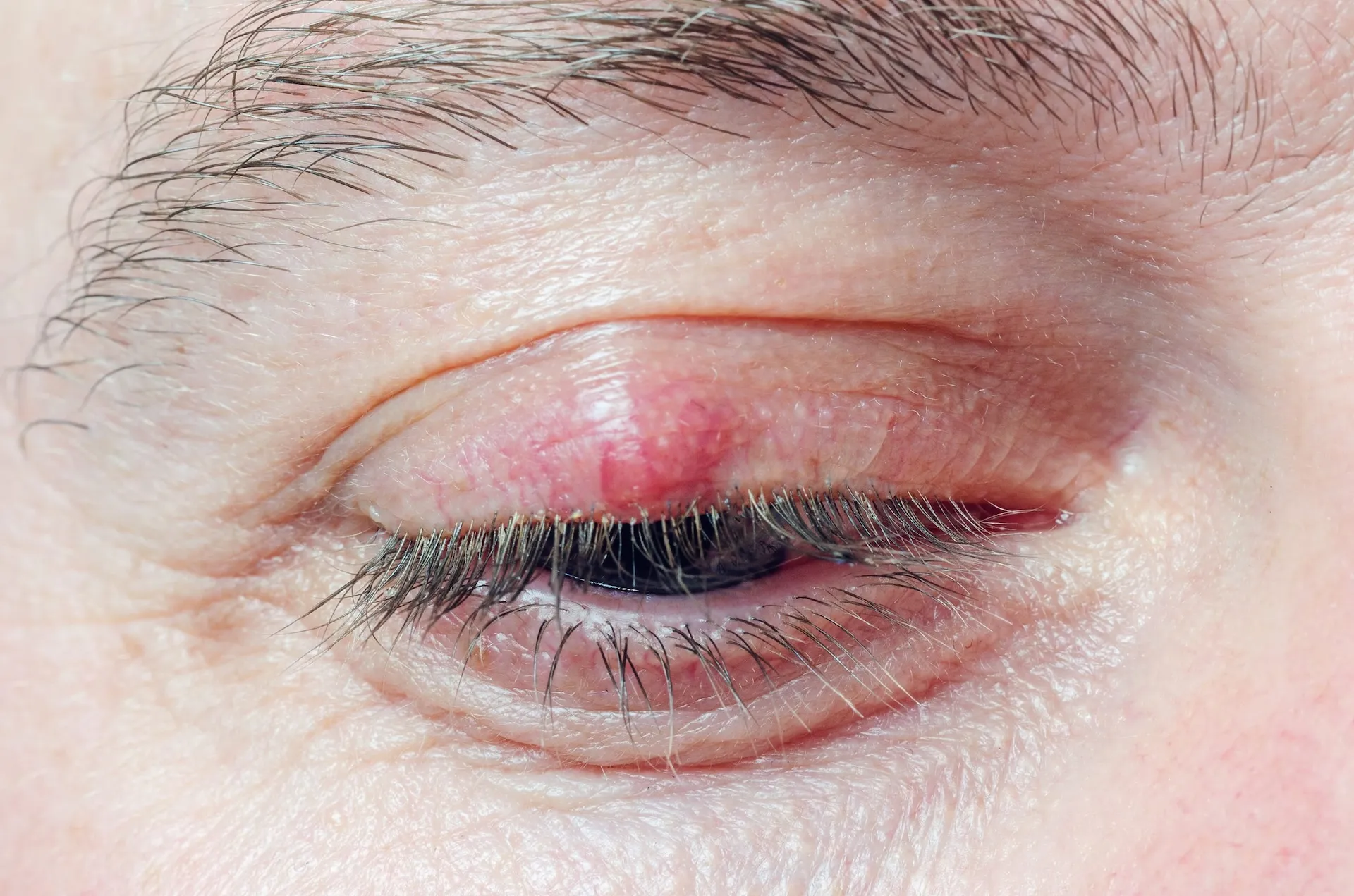 Chalazion Excision