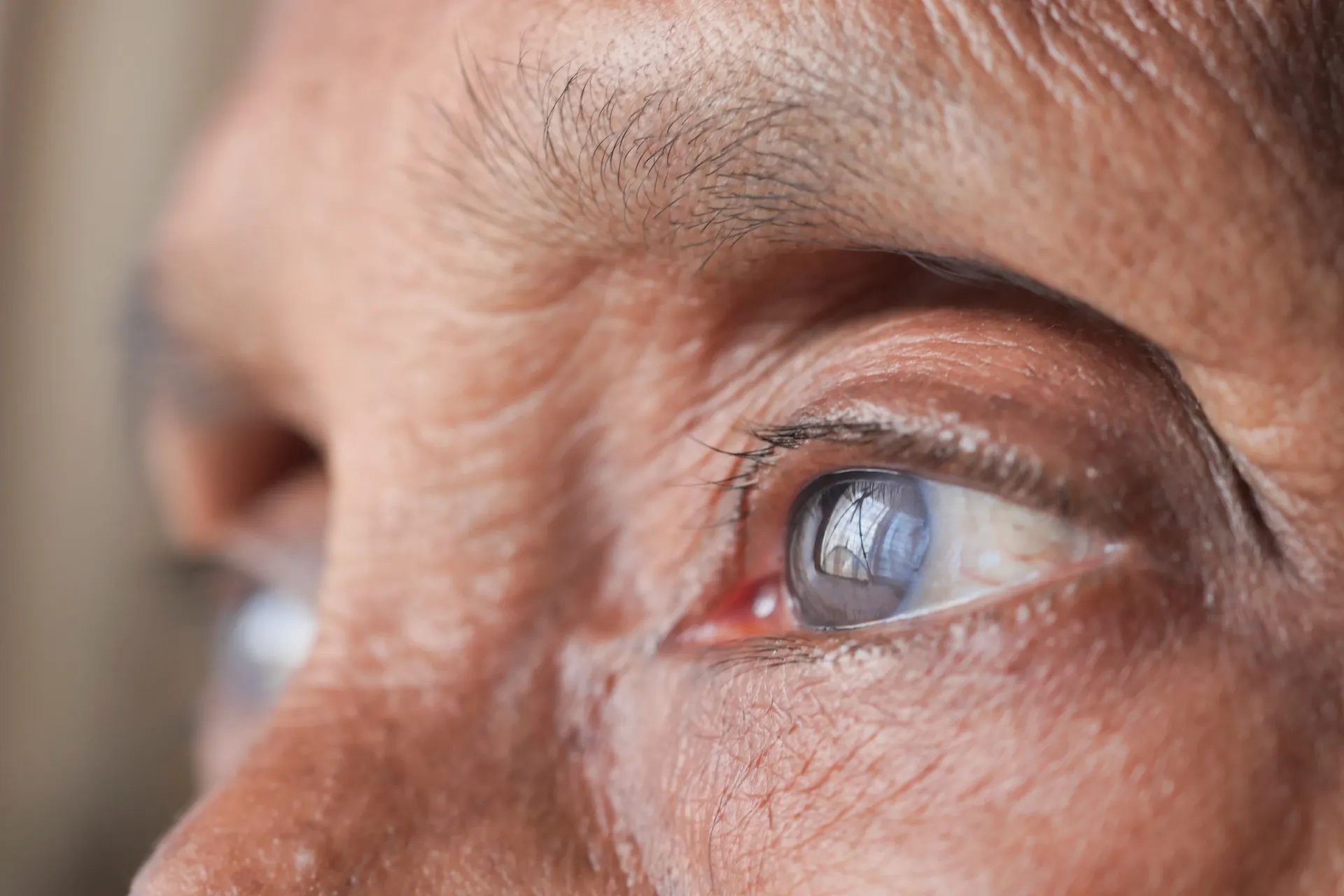 Pterygium Excision
