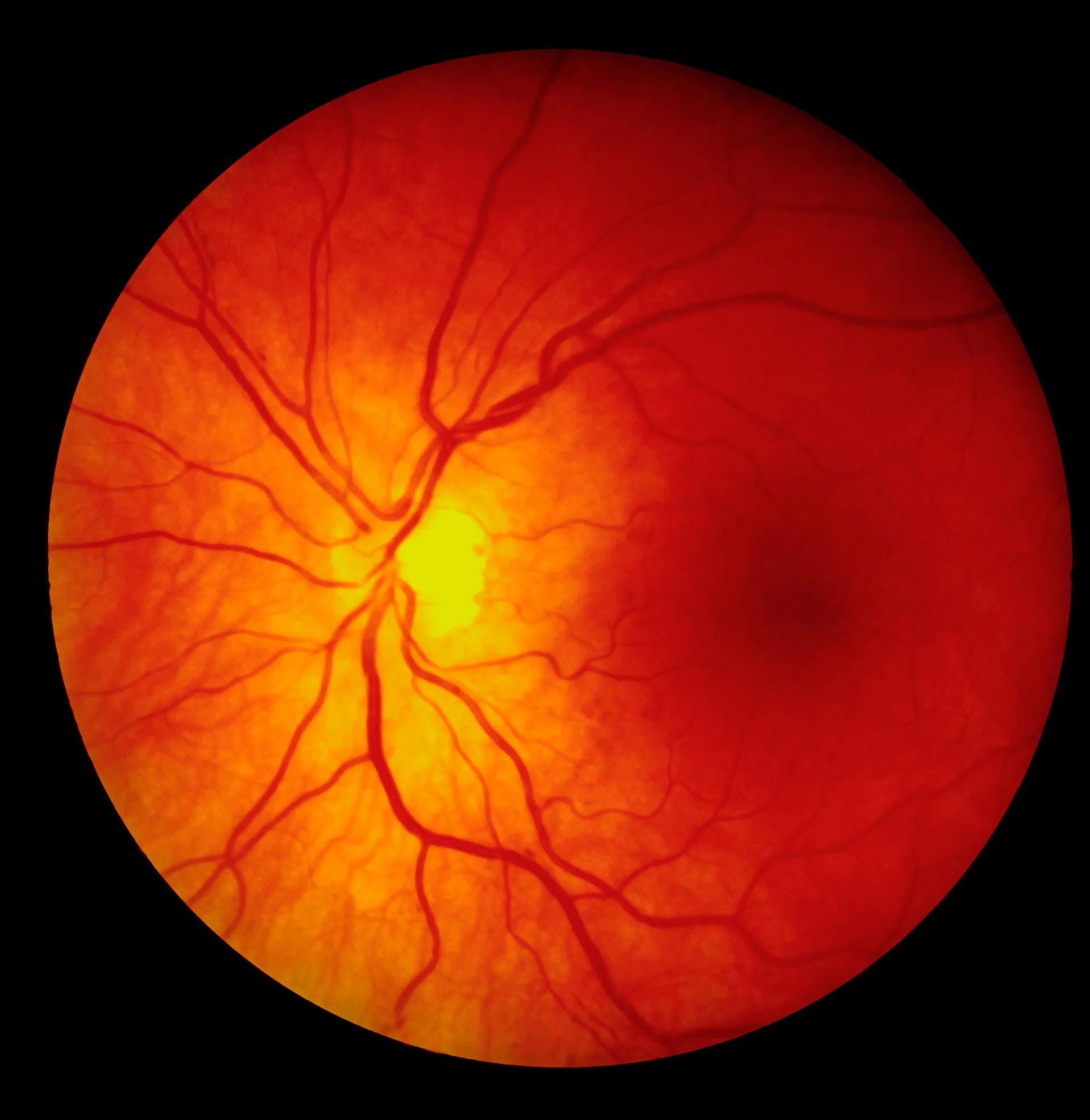 Pan Retinal Photocoagulation