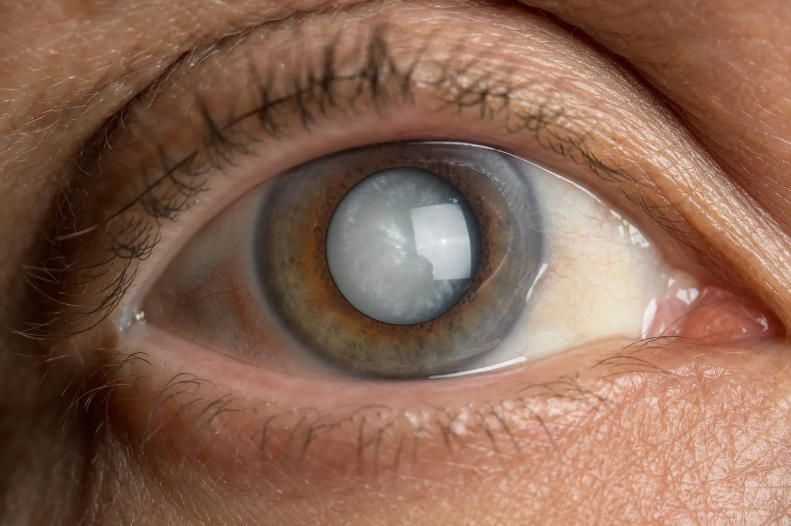 Cataract Surgery