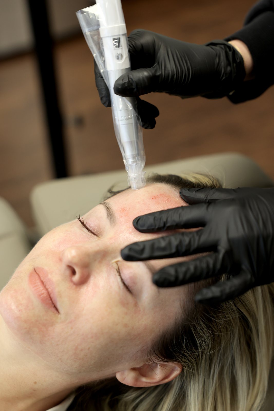 Microneedling treatment at a med spa client